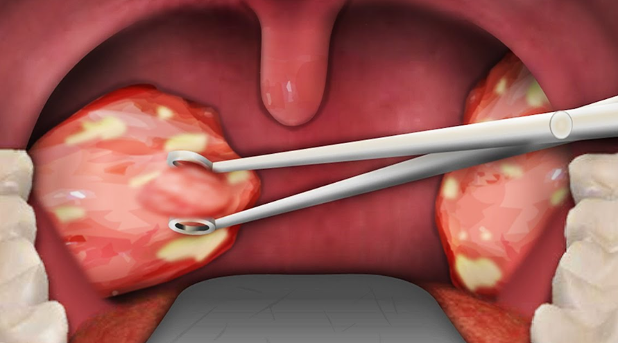 TONSIL REMOVWL IN