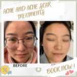 Acne scars0