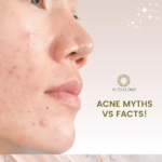 Acne scars1