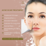 Acne scars2