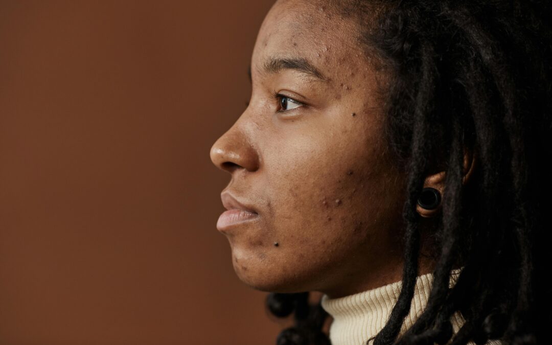 What Causes Acne?
