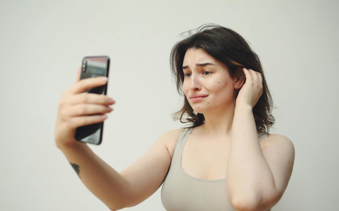 How To Treat Acne Scar?