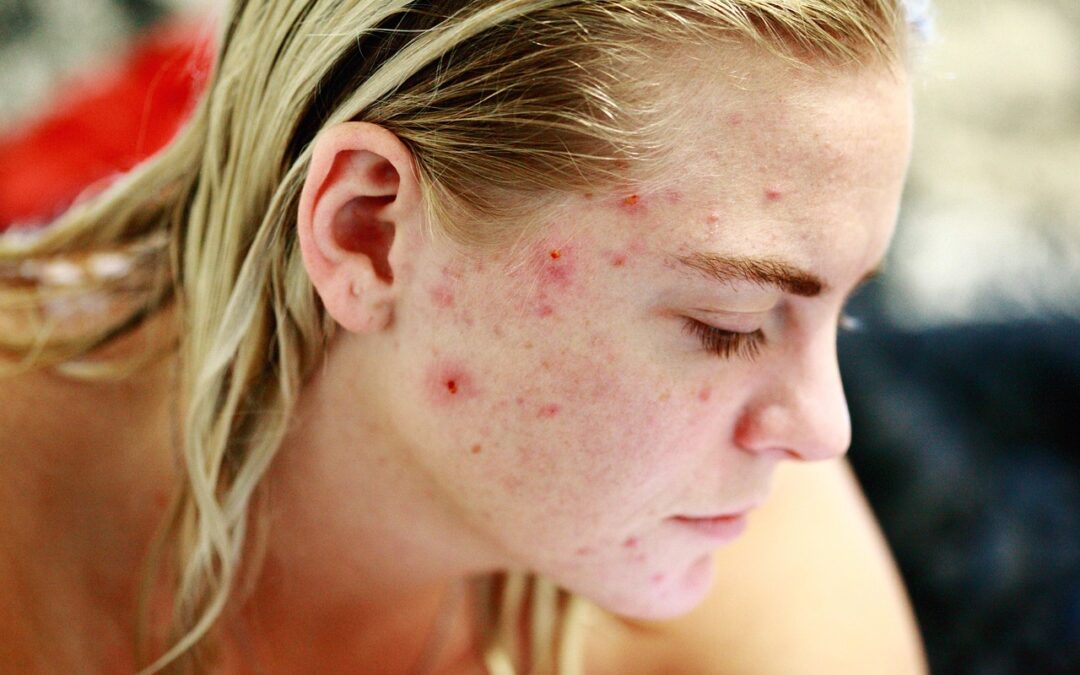 Best Treatments For Acne Scars