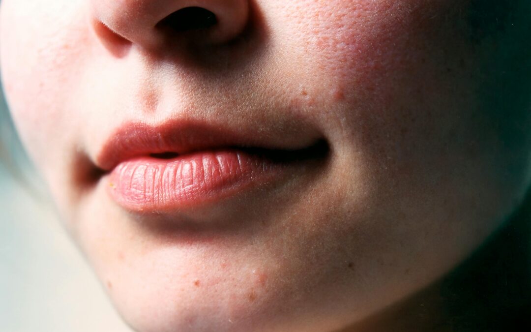 Everything You Need To Know About Eczema