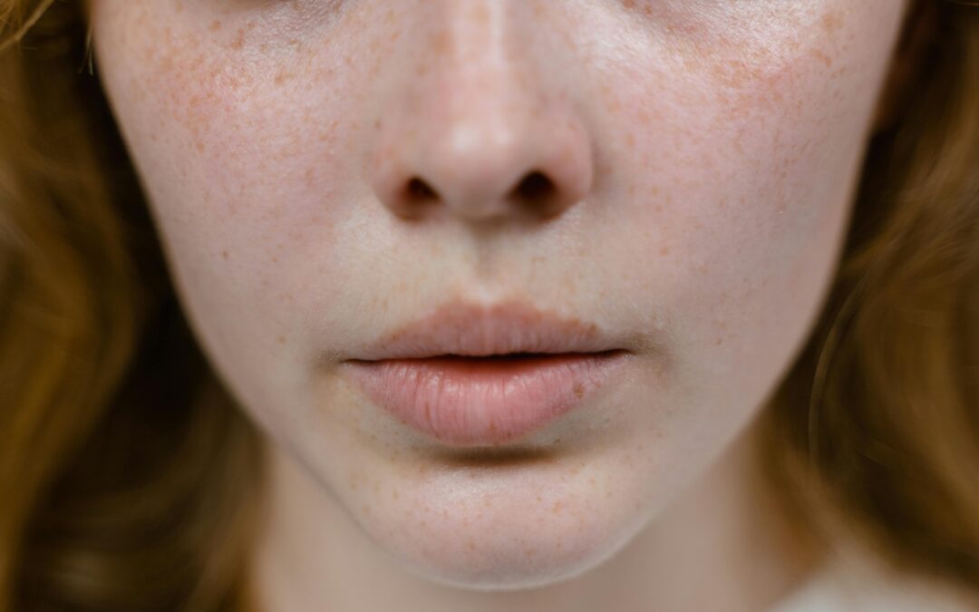 How Is Eczema Diagnosed?