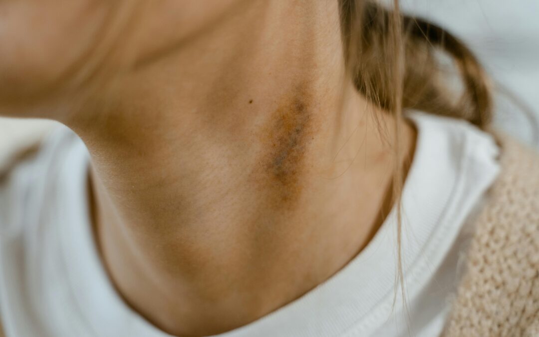 How To Get Rid Of Eczema?