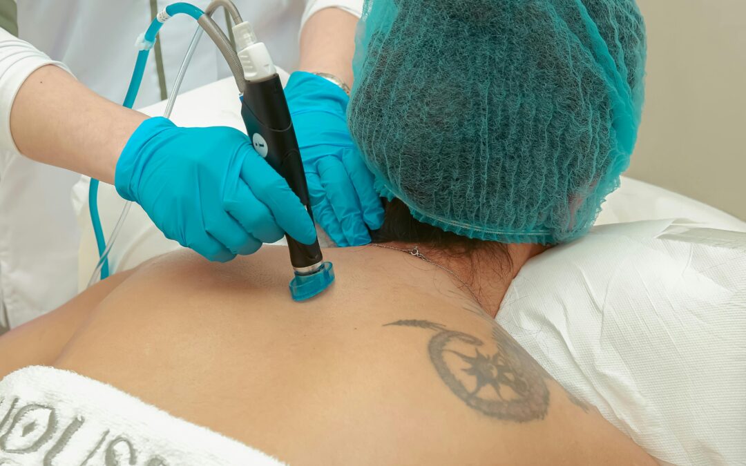 What Is Tattoo Removal?