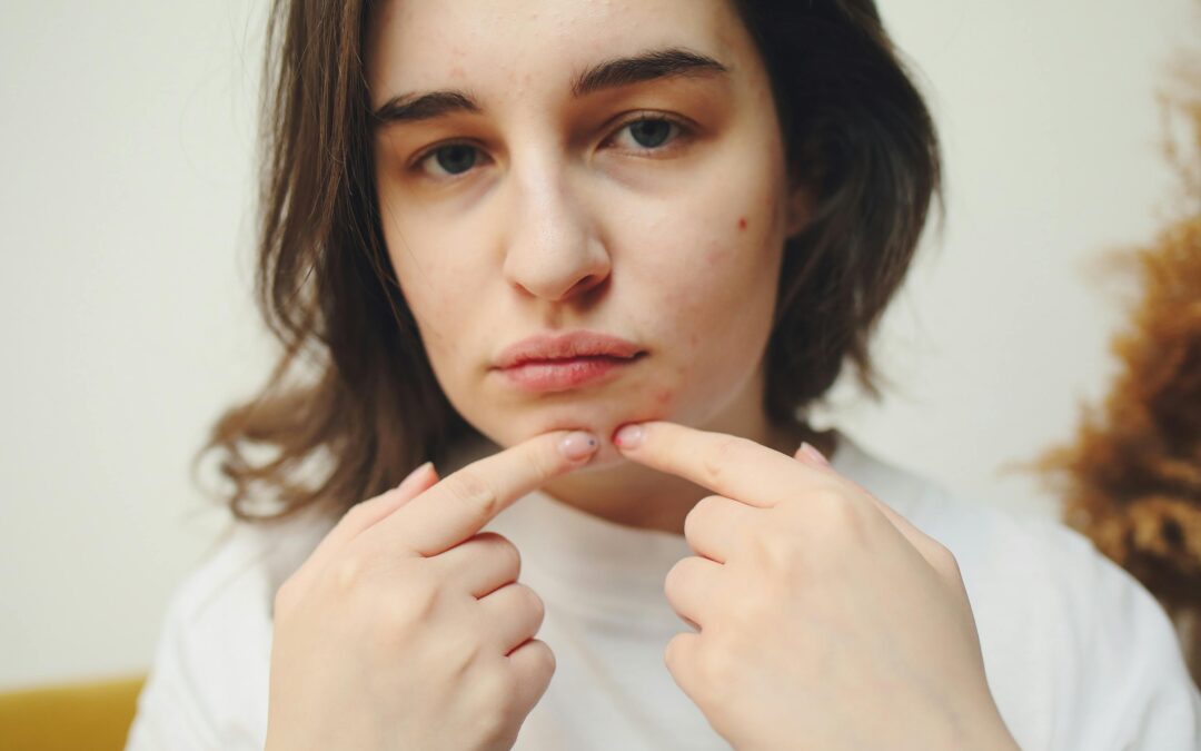 Everything You Need To Know About Acne Scar Treatment Procedure In Singapore