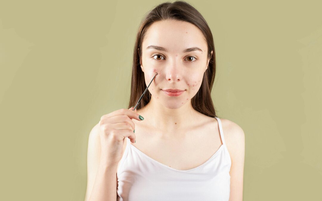 Acne Scar Treatment In Singapore