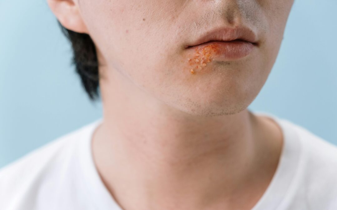 Eczema Treatment In Singapore