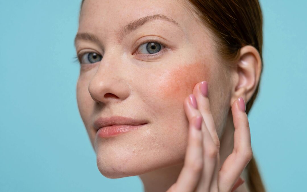 Management And Treatment For Milia Removal In Singapore